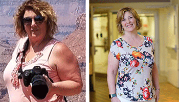 BIDMC Weight Loss Patient Laurie Busa Before and After