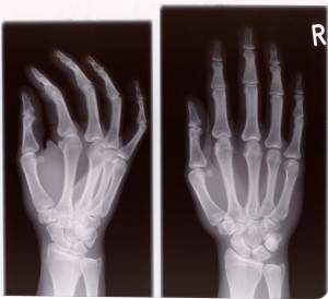 X-ray of hand surgery