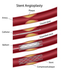 stent angioplasty illustration