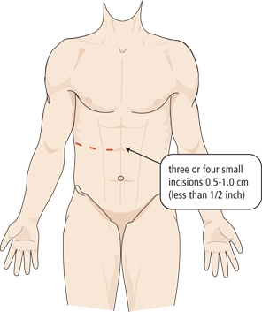 adrenalectomy