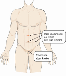 LRNx Incisions