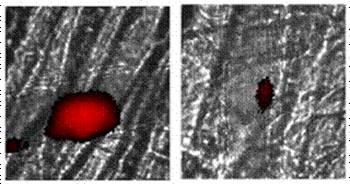 Thrombus formation