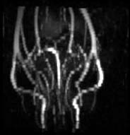 Angiography