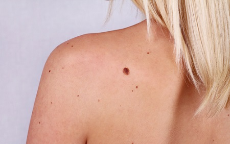 How to do a self-check for skin cancer (Women's Health)