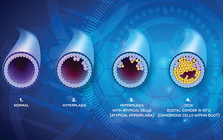 Treating Ductal Carcinoma In Situ (DCIS)