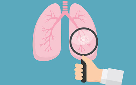 Lung Cancer - A strategy to improve survival rates
