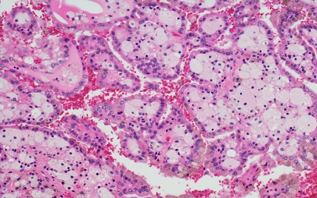 Blood Test Could Detect Kidney Cancer Up to Five Years Prior to Clinical Diagnosis
