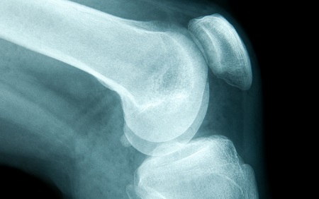Beyond Bone Mineral Density: Assessing Additional Bone Traits Helps ID Those at Risk for Fracture