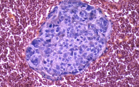 Crunching the Numbers of Cancer Metastasis