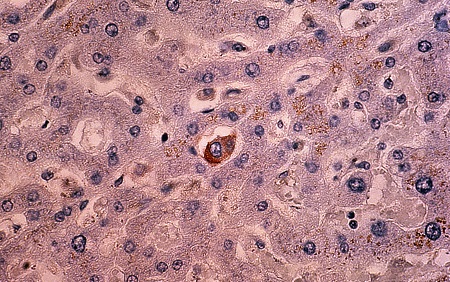 Breast cancer cells (Tung)