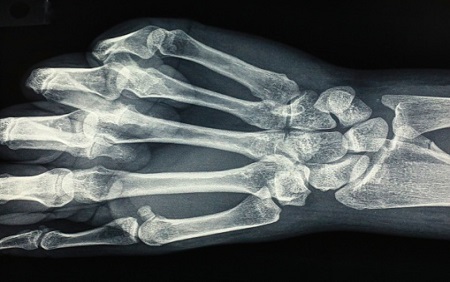 Do obesity and smoking impact healing after wrist fracture surgery?