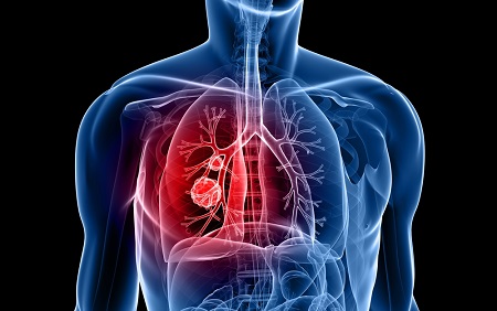 Study examines how hospital payments for heart attack care may affect patient outcomes