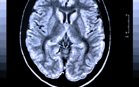 The Impact of Type 2 Diabetes on Brain Health