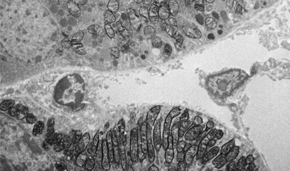 Mitochondrial Metabolism Linked to Acute Kidney Injury