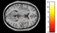 In a Nutshell: Walnuts Activate Brain Region Involved in Appetite Control