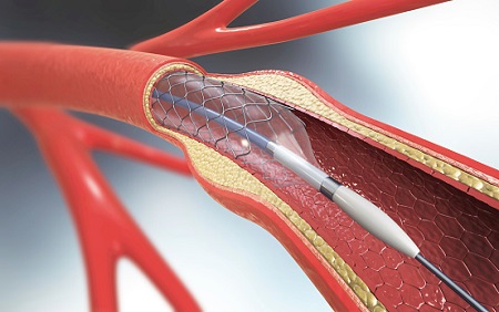 Less-invasive stenting procedure linked to better outcomes in patients at risk for stroke