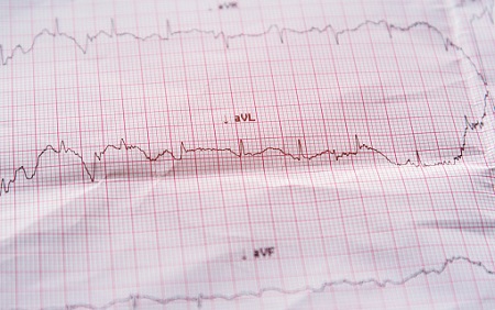 Heart Attack Rate Falls Steeply for Older People