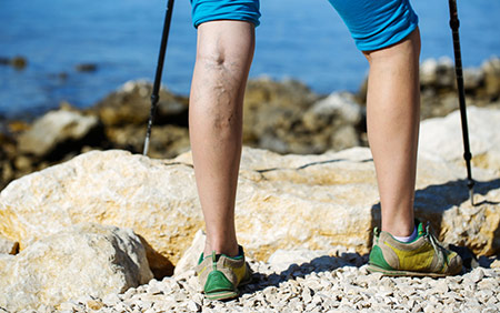5 Tips for Leg Health