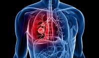 new subtype of lung cancer