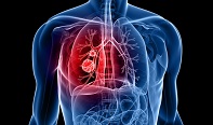 Researchers Inhibit Tumor Growth in New Subtype of Lung Cancer