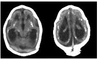 zika brain scans
