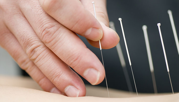 Acupuncture Treatment