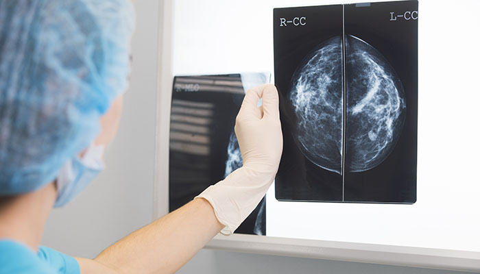 Breast Cancer X-rays