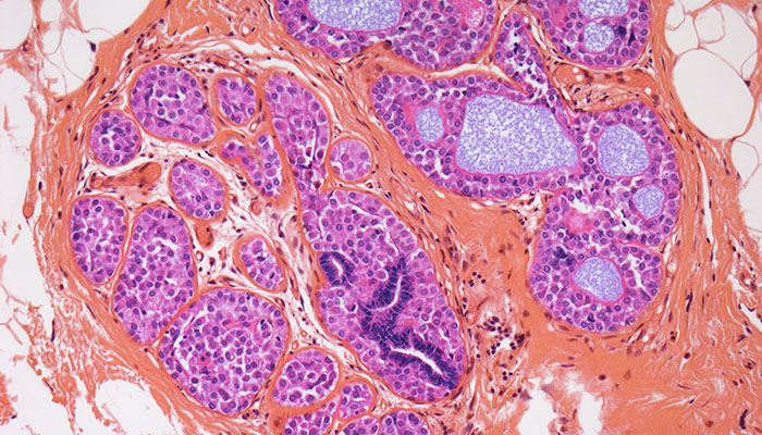 Ductal Carcinoma In Situ (DCIS) - Stage 0 Breast Cancer