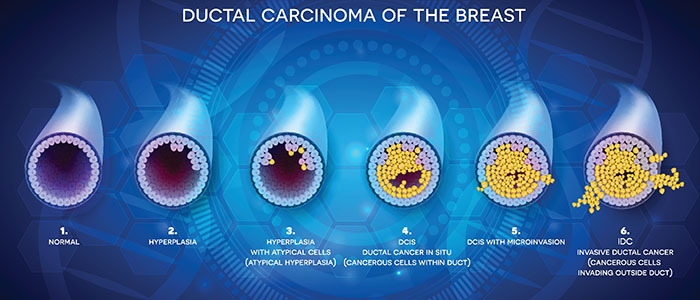 DCIS Infographic