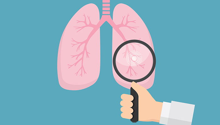 Lung Cancer Screenings