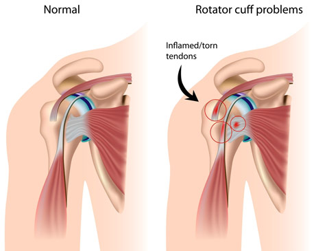 shoulder