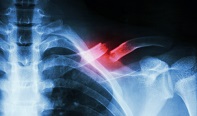 fracture