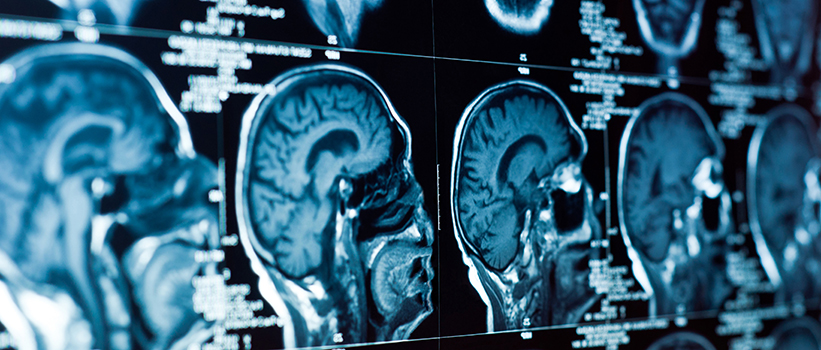 Brain Function Scans
