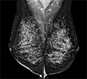 Comparing 3-D Mammography to 2-D Mammography