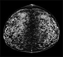 Comparing 3-D Mammography to 2-D Mammography