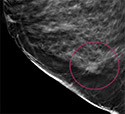 Comparing 3-D Mammography to 2-D Mammography