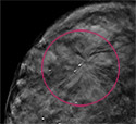 Comparing 3-D Mammography to 2-D Mammography