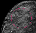Comparing 3-D Mammography to 2-D Mammography