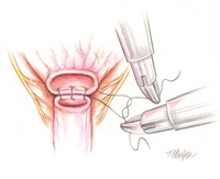 Robot anastamosis
