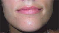 lips before 2