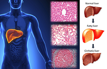NAFLD