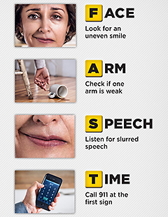 Stroke And Cerebrovascular Diseases Bidmc Of Boston