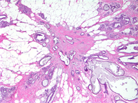 Breast Pathology - Radial Scar