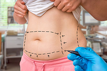 Plastic Surgery - Liposuction Diagram on Belly