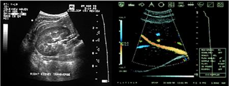 Abdominal Ultrasound
