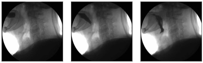 Videofluoroscopy