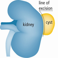 Laparoscopic Renal Cyst Decortication