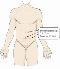 Open Kidney Incision