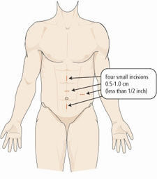 LpartialNxincisions