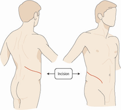 Open Kidney Incision